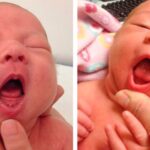 Is Tongue Tie Surgery Necessary for Babies? Experts are divided - National