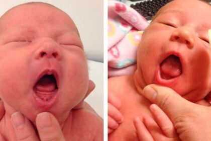 Is Tongue Tie Surgery Necessary for Babies? Experts are divided - National