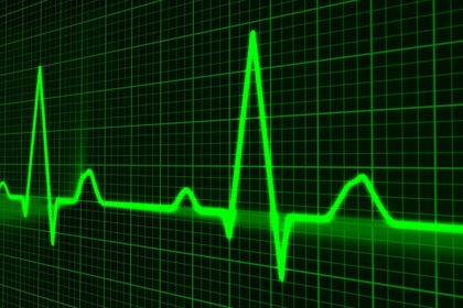 Atrial fibrillation is estimated to be three times more common than previously thought