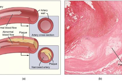 Metals in the body from pollutants linked to the progression of harmful plaque buildup in the arteries