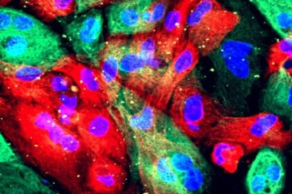 Protein NSD2 appears to stimulate the early development of prostate cancer